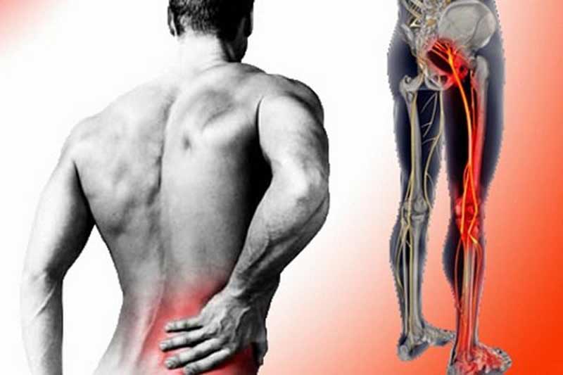 Đau lưng và mông là dấu hiệu của bệnh viêm cột sống dính khớp