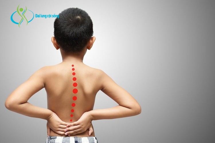 Gãy xương do căng thẳng là nguyên nhân đau lưng ở trẻ em