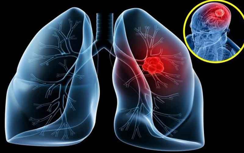 Mắc các bệnh về ung thư phổi gây cơn đau xương sườn